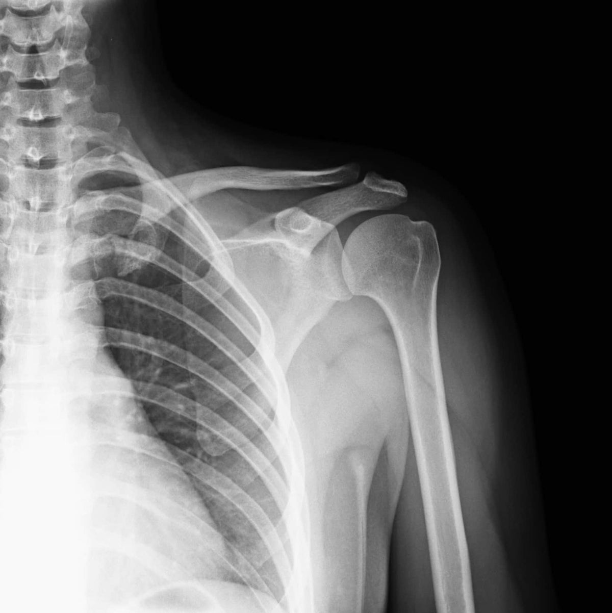 Arma origin shoulder pain in combat sports and boxing